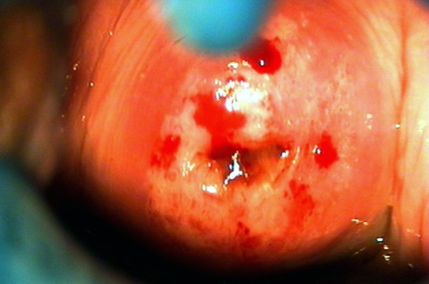 Lesiones Intraepiteliales del Cuello Uterino. Seguimiento durante 20 Años de Pacientes Tratadas con Radiofrecuencia